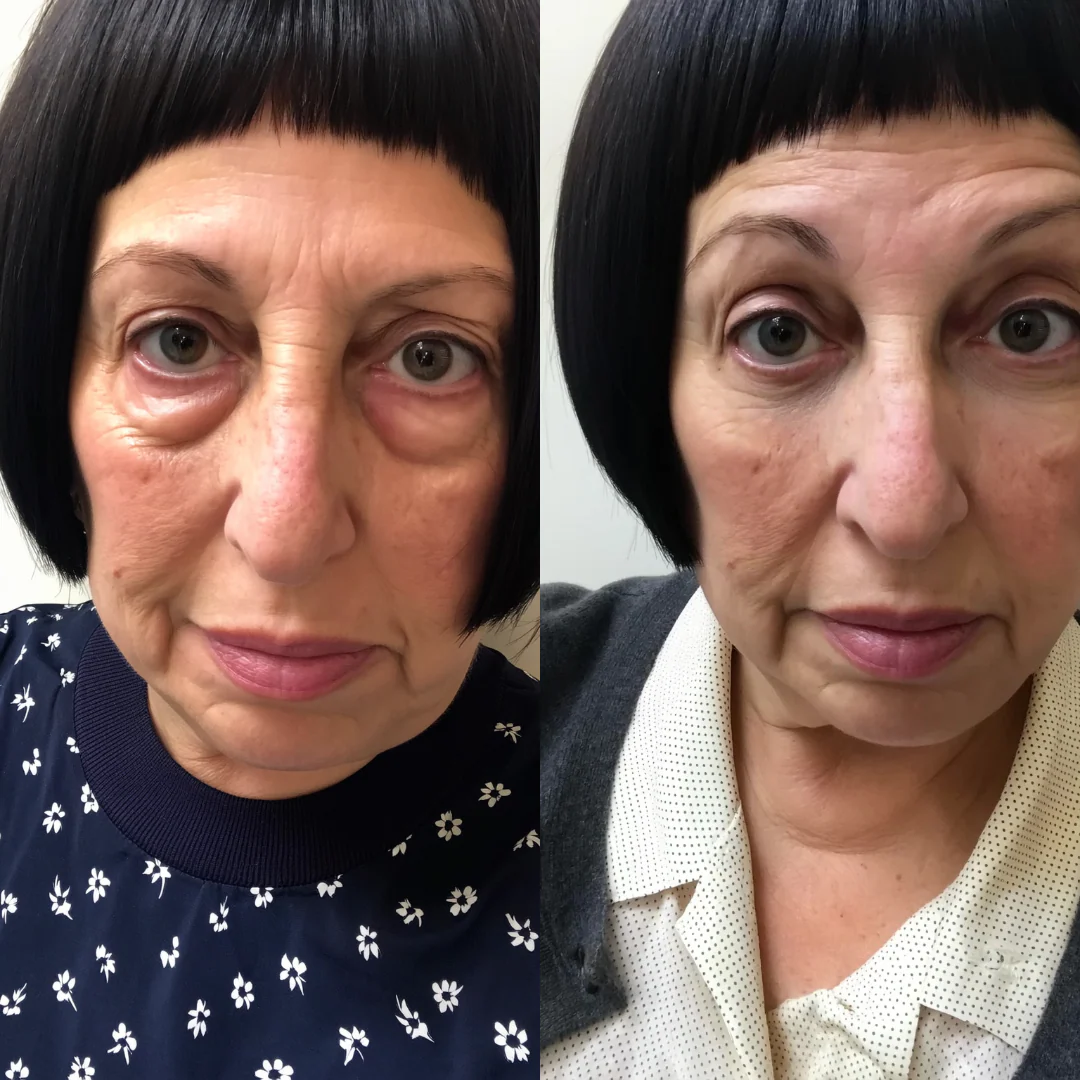 GlowLuxe® 2-in-1 Red Light + EMS To Erase Eye Bags